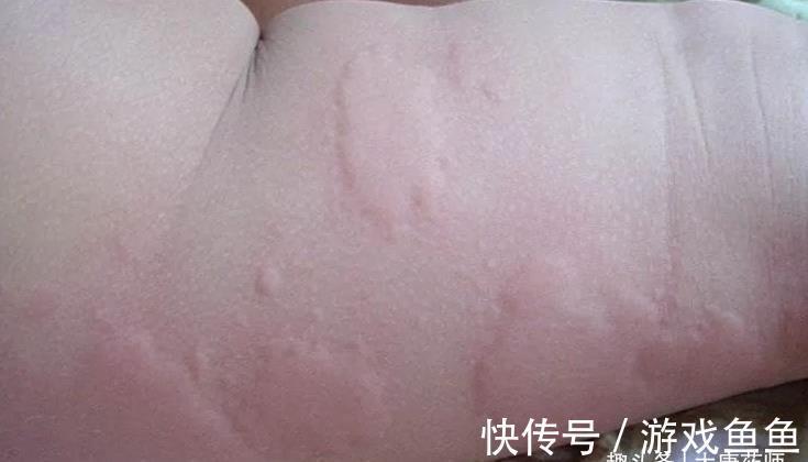 浊气|三伏化淤黄金期！灸4穴，调和气血，打通全身瘀血，预防各种结节