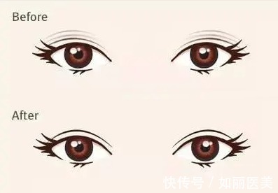 修复术 【功课】双眼皮修复术后常见注意事项，做到这些恢复后更自然！