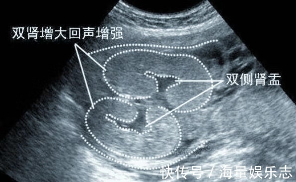 孕晚期|胎儿双肾盂分离，孕妇很高兴，“这下儿女双全了”，医生苦笑摇头