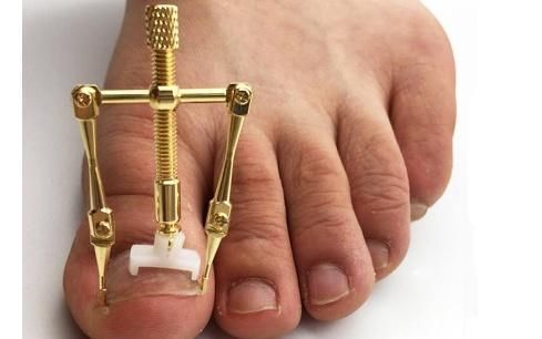 修剪|指甲长进肉里,一走路就疼,一个小办法可能对你有帮助,不妨一试