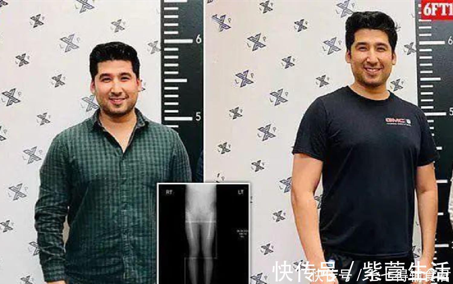 伸缩器|男子花费58万“拉骨”,只为增高5厘米,网友们大呼无法理解