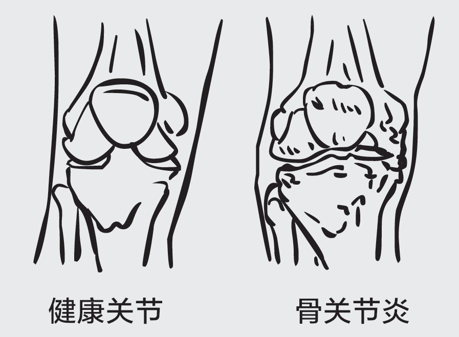 关节|如何才能把骨刺消掉？