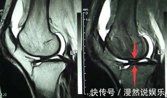 事儿|运动后，你的半月板还好么关于半月板的这点儿事儿！