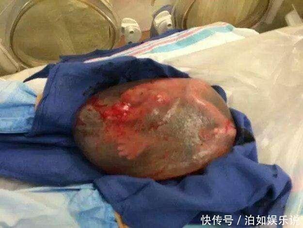 羊膜|现实版“哪吒”,产妇生下“带壳”宝宝想遗弃,医生却说恭喜你