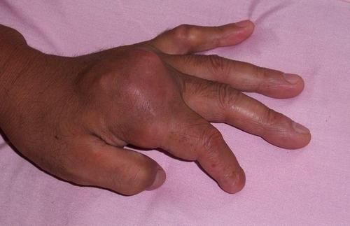 海鲜|海鲜是痛风的“发物”？尿酸高的人，“4鱼1豆”要少碰