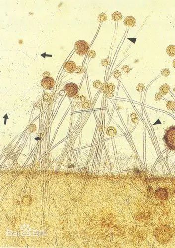 玉米|【警惕】回家帮忙收玉米后，肺部竟然长满真菌？这个霉菌，离你很近→