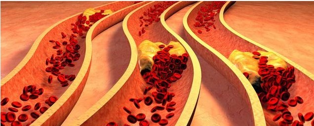 甘油三脂|10个人里就有4个高血脂,血脂怎样吃回去有几个方法快告诉家人