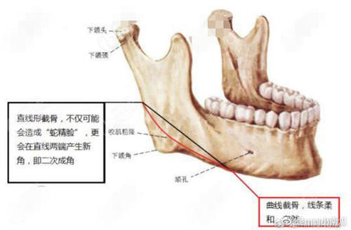 磨截联合长弧线下颌角整形比普通下颌角手术好在哪儿？风险更小吗？