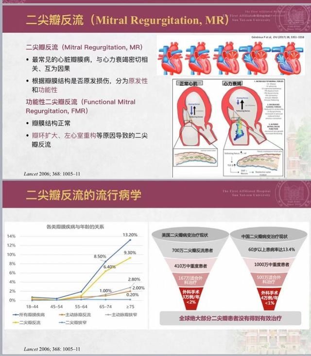 附属第一医院|小创口输送夹子“堵漏”，患病率最高的瓣膜病能微创治疗了