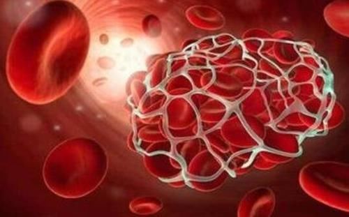  不明原因|如何得知身体有没有血栓, 医生给出5个自测标准, 看看你有吗!