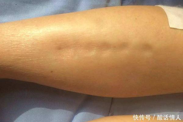 尿酸高,睡眠先知睡觉有什么异常,暗示尿酸已过“安全线”