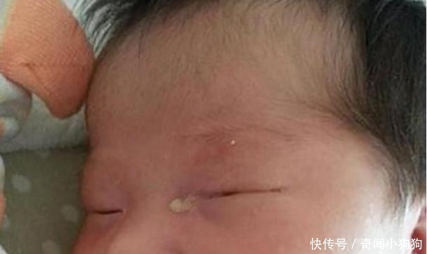 半岁女孩发烧, 医生将针扎入眼角, 眼角流出液体, 母亲无法淡定