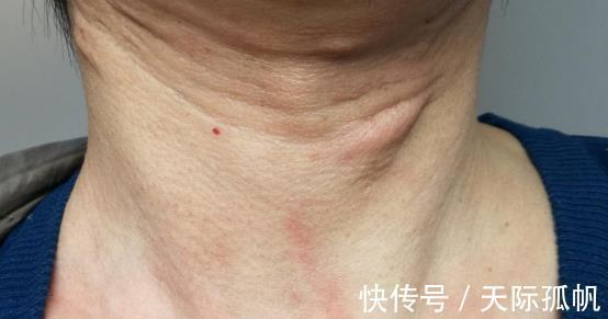 海鲜|甲状腺有结节不能吃海鲜?医生:其实不是,“1黄、2绿”要少碰