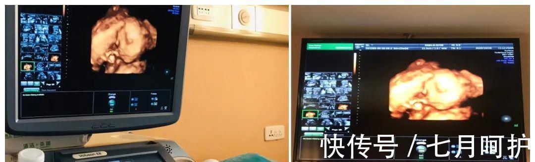 医生|孕妈做四维为什么不能让家属陪同?做完检查之后才知道医生的良苦