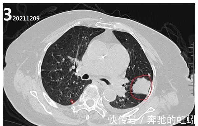 ct|如果不治疗的话,肺癌的发展速度到底有多快?