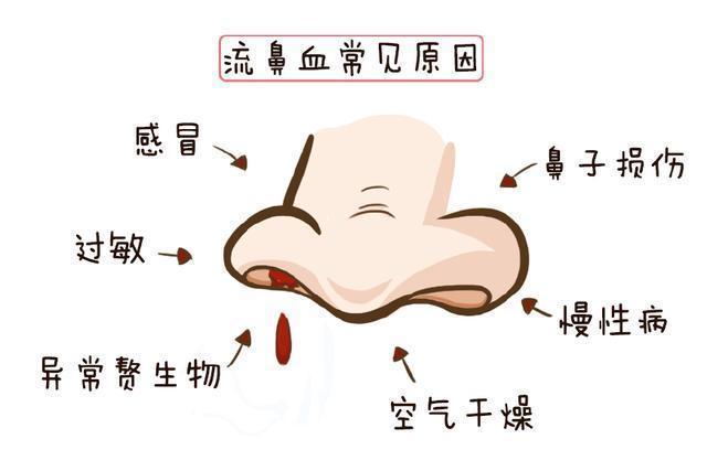 白血病|孩子流鼻血就仰头?做错了!不能这样