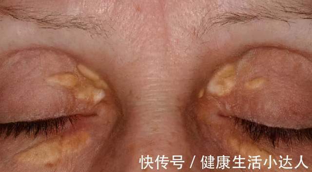 碳水化合物|血脂高了危害大，提醒：一旦臉上出現3種變化，要注意忌口了