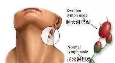 瘀血|大气磅礴的方子，结节、增生、肌瘤、囊肿，通治从头到脚各种包块