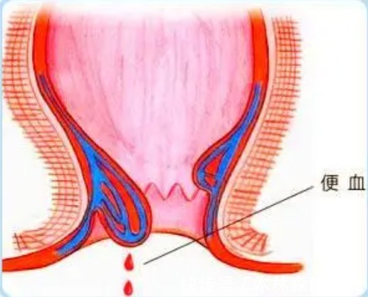 治疗|辟谣：痔疮可以不治疗会自己好。让肛肠科主任来告诉你：这是假的！