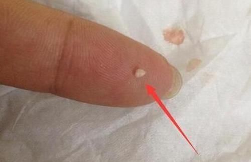 鼻子两边总是会挤出白色条状物？越挤越多？今天就给大家科普一下！