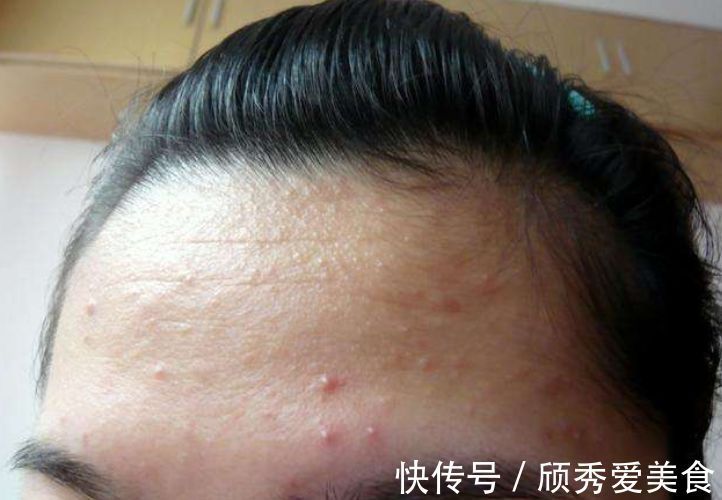 金银花|5个信号一出现,肝火“烧”起来了,自己动手,给肝“去去火”