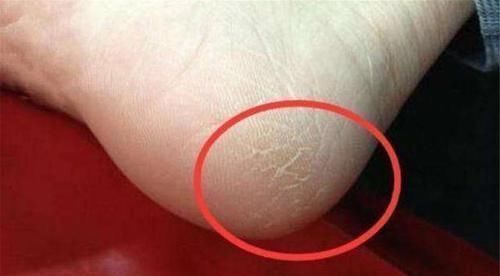 热水泡脚|脚后跟容易出现“干裂”，可能是几个原因导致，可别忽视了