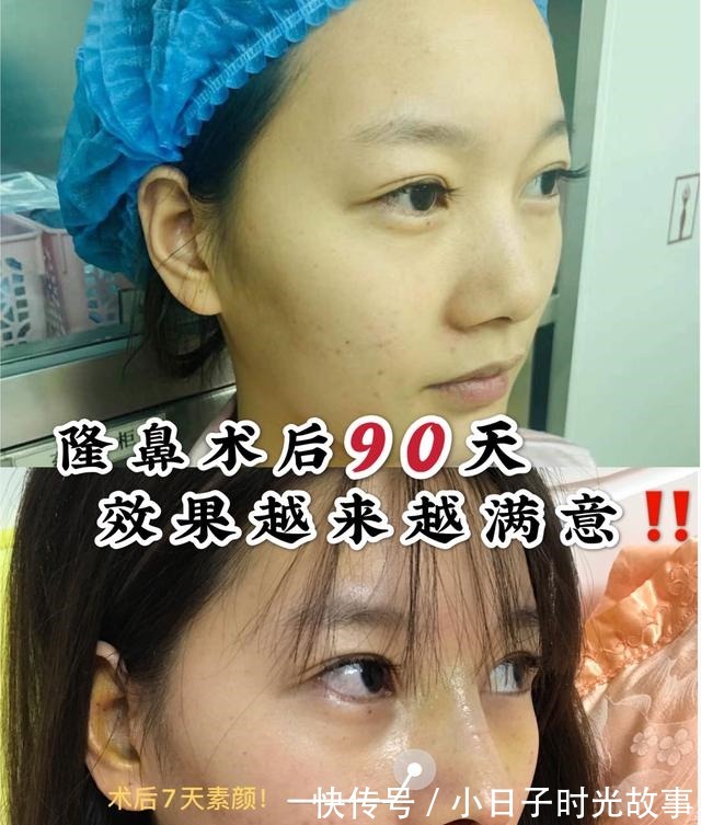 隆鼻 隆鼻手术90天,对于效果越来越满意!隆鼻手术90天,对于效果越来越满意!