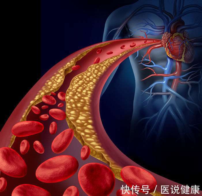 身体|血管堵塞,危害不容小觑,身体这6处会受到影响,需重视起来