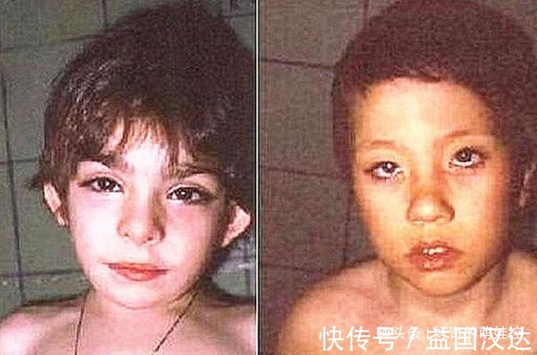 歌舞伎面谱综合征|有一种病叫“孩子太漂亮”,天生自带眼妆,是产检查不出的罕见病