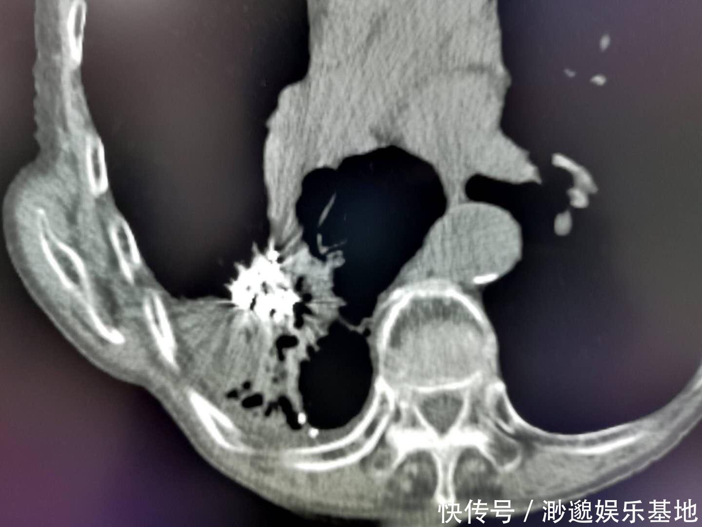 明明知道癌症治不好,为什么医院还有治呢?