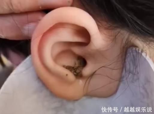 棉花棒|粗心妈妈以为孩子反应迟钝原来是耳垢填满耳朵,导致孩子听不到