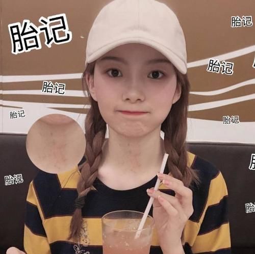 包容度|被“胎记”耽误前程的明星，陈卓璇能用粉底遮盖，他却令人可惜