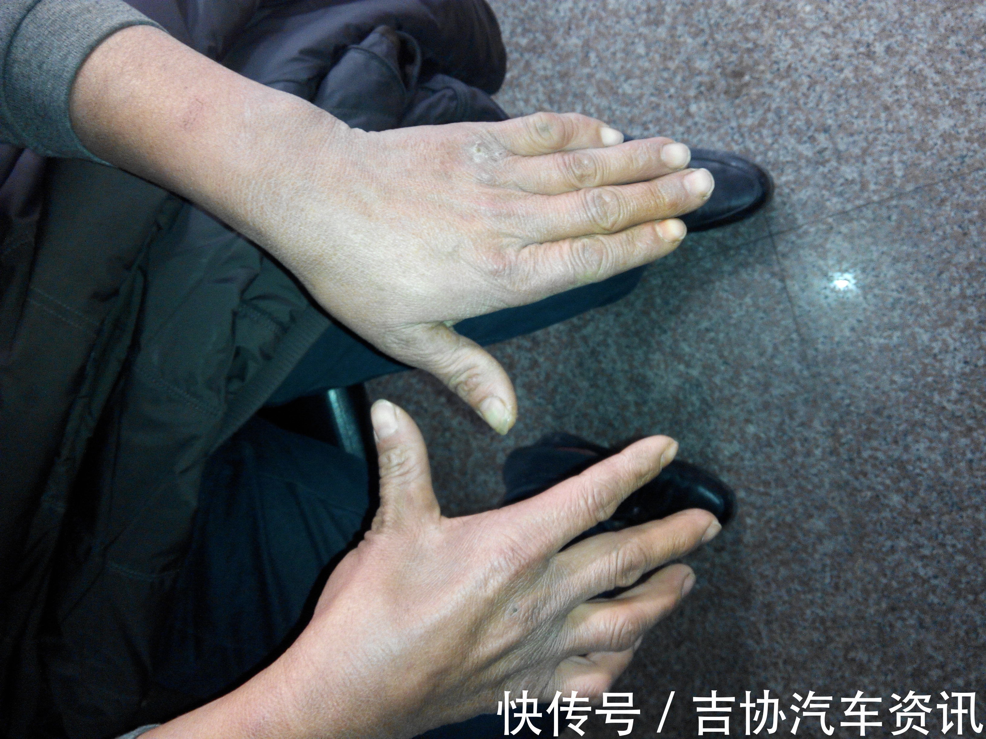 肌肉萎缩|运动神经元肌肉萎缩怎么办？