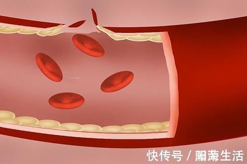 剂量|血压160110，属于几级高血压？如何降压才安全？医生分析给你听