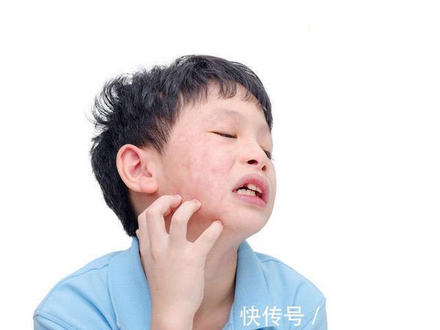 盐酸西替利嗪|儿科医生带孩子出门保平安的常备药物攻略,家长必读