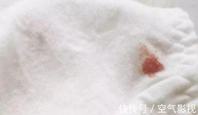 分泌物|48岁女老板,宫颈病变2级转阴,HPV消失了,全因做好一事