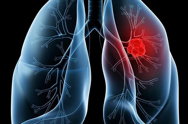 日常生活中|为什么越来越多的人会患上肺癌 听听医生是怎么说的!