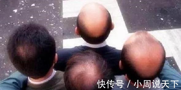 发型 地中海发型和戴假发,你更不能接受哪个!