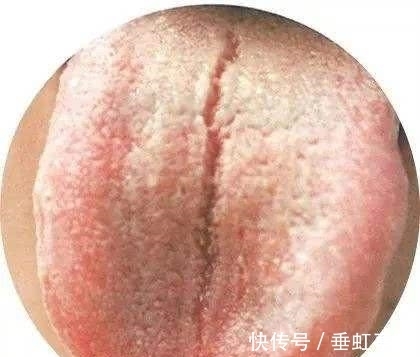 裂纹|胃炎多久变胃癌?舌头有裂纹,必须当心了
