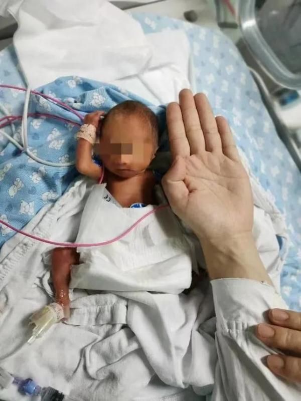 早产|超早产“巴掌宝宝”，115天生命闯关！看哭了……