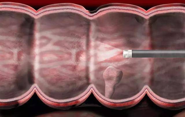 肠道|大肠癌的真凶找到了,医生忠告,50岁人群务必远离四种生活习惯