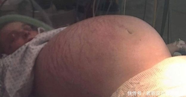 怀孕|英国女子“怀孕三年”,检查后结果让大家恍然大悟