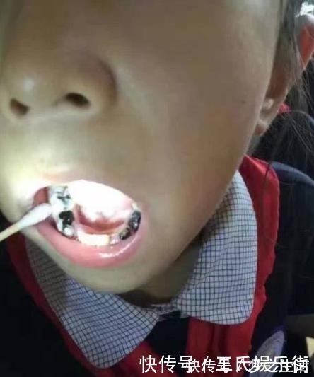 散散步|孩子被嘲笑“嘴太臭”,被同学孤立,医生取出小颗粒,宝妈都嫌臭