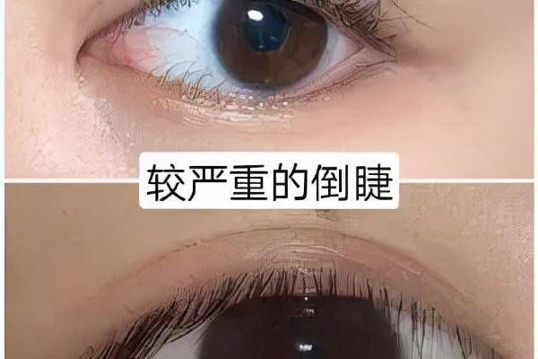 结膜炎|杭州眼整形徐刚主任：经常揉眼睛不一定是困，有可能是倒睫