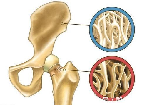 骨质疏松|中西医如何治疗骨质疏松?一篇文章给您梳理的清清楚楚