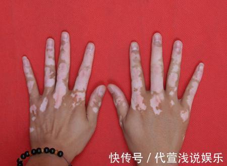 胎记|要想宝宝出生后不长胎记,孕期避免这几件事就OK,你做到了几条