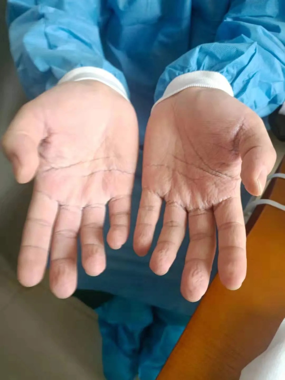 护士长|为了这群特殊的血液透析患者!