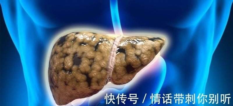 优质蛋白|为什么一直吃素还得脂肪肝?专家提醒:脂肪肝最怕的,不是脂肪!