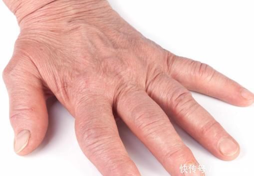 肺癌不痛不痒早期手上这些病症,已经多次提醒你