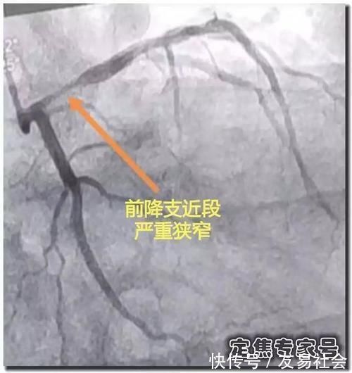 硝甘|从“上火”到心肌死亡仅5天！牢记16个字，必要时能救命